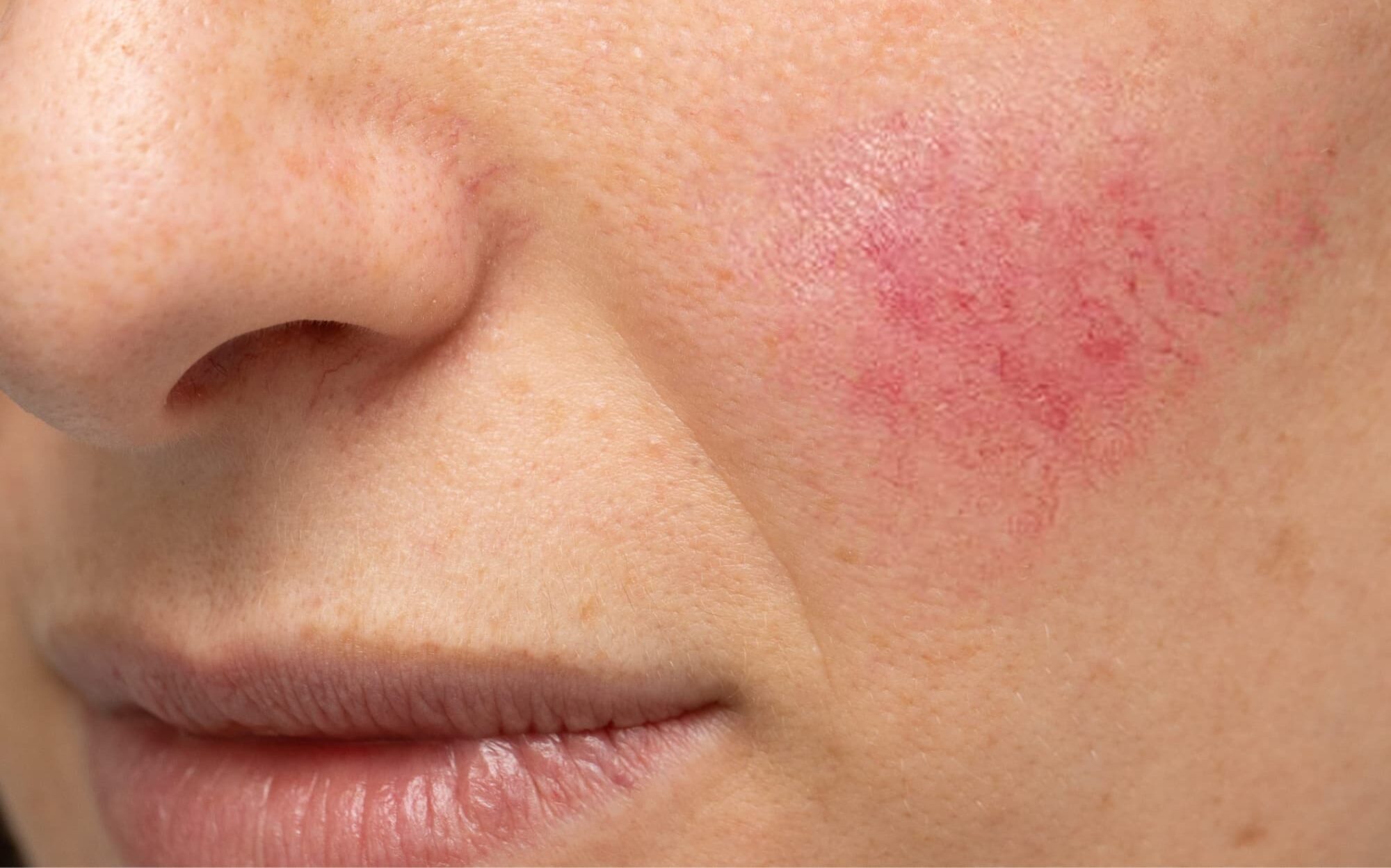 Rosacea is a skin problem characterized by a red face and cheeks. But rosacea is more than just skin redness, and the symptoms can progress as the condition worsens.