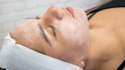 About chemical peels