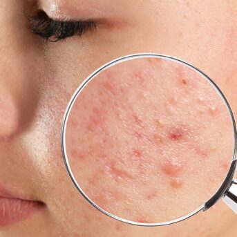 remove acne