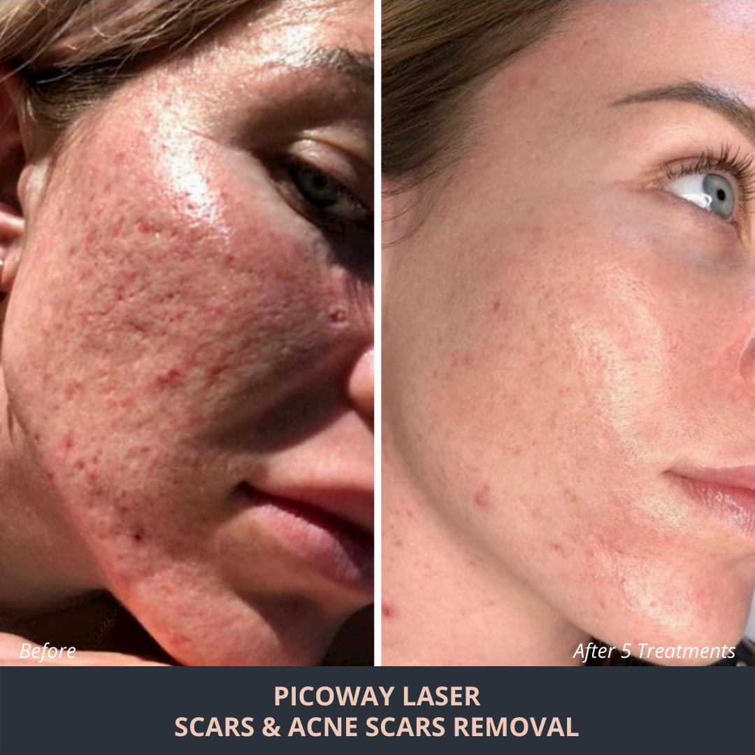 acne-scars-removal-results