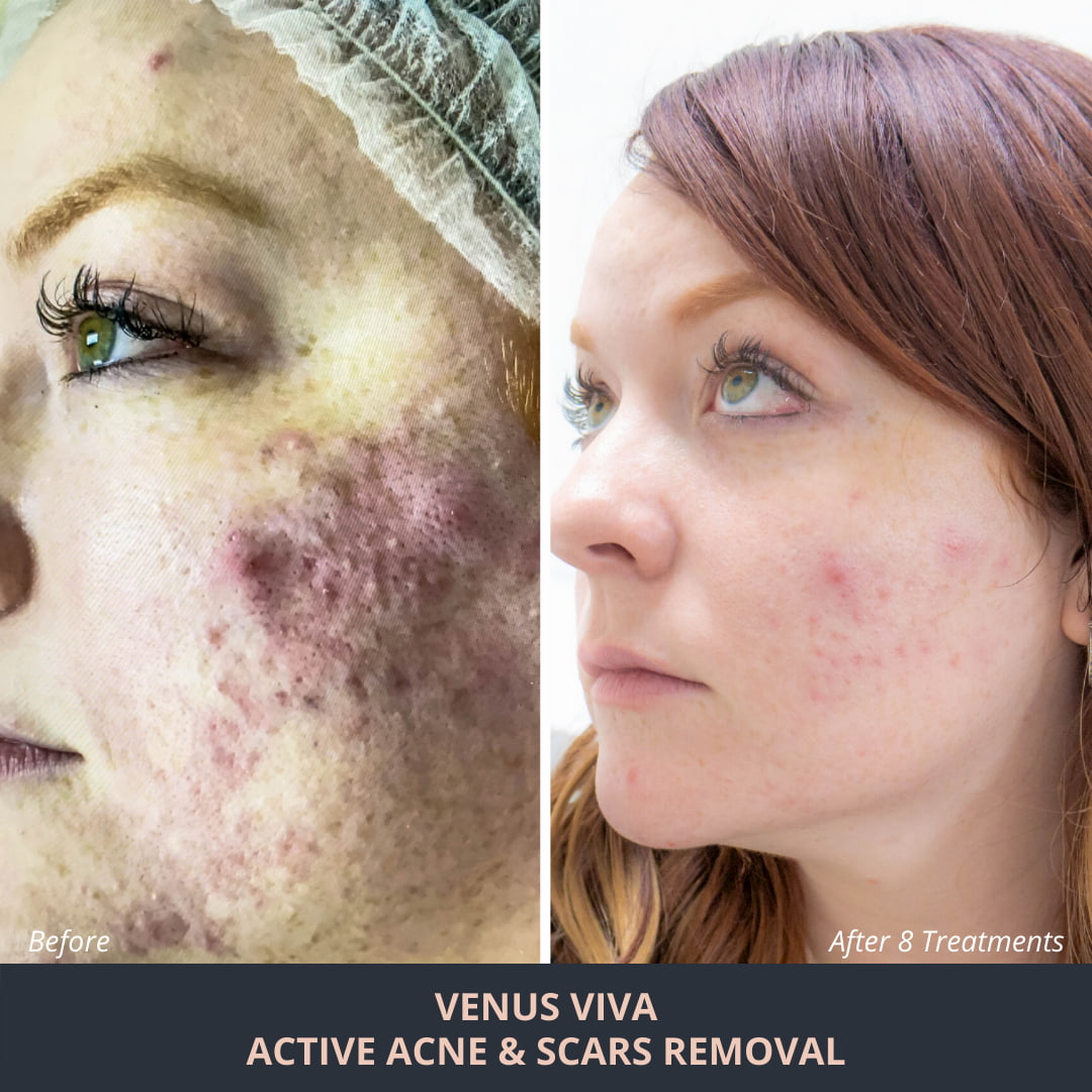 active-acne -scars-removal-result