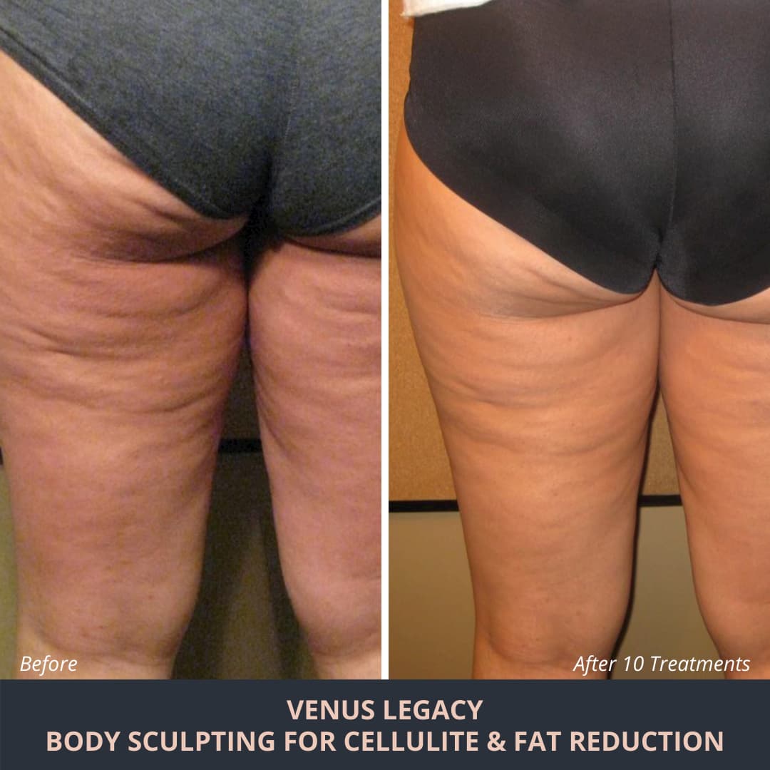 https://www.novuskin.com/wp-content/uploads/2021/10/cellulite-treatment-before-after.jpg