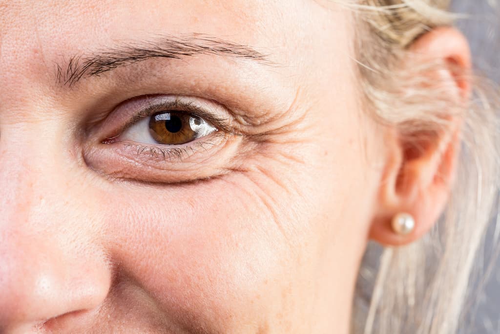 Eye bags and dark circles under eyes treatment: help reduce puffy