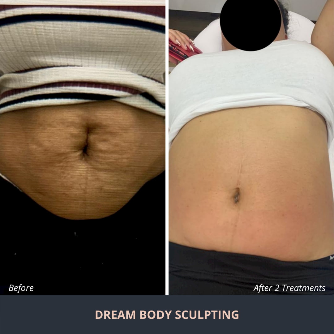 dream-body-sculpting-result