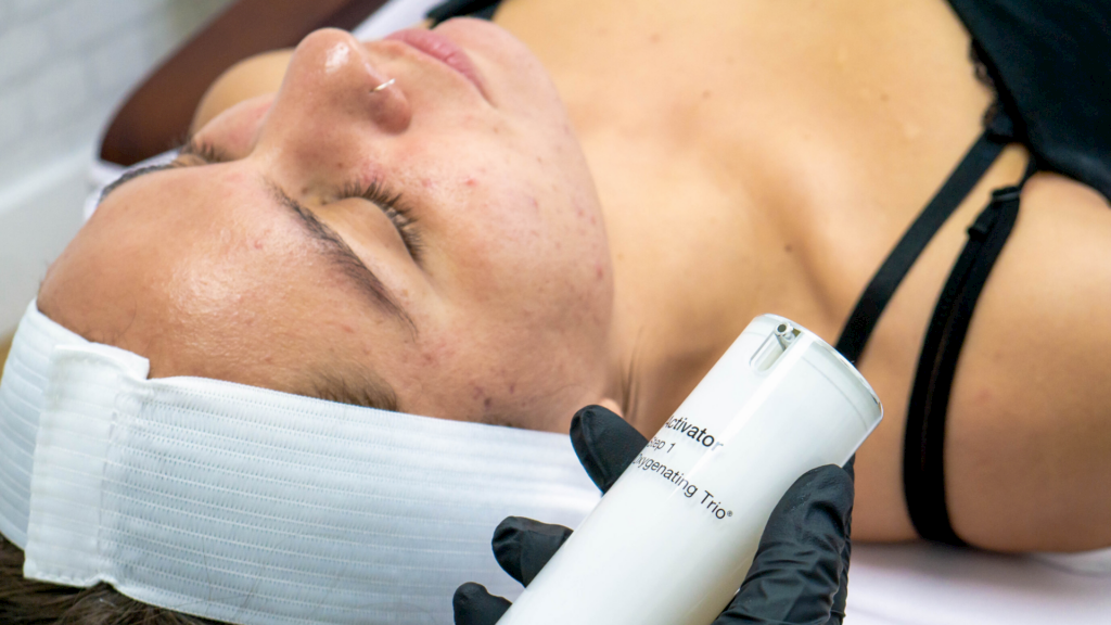 Everything you Need to Know About Chemical Peels