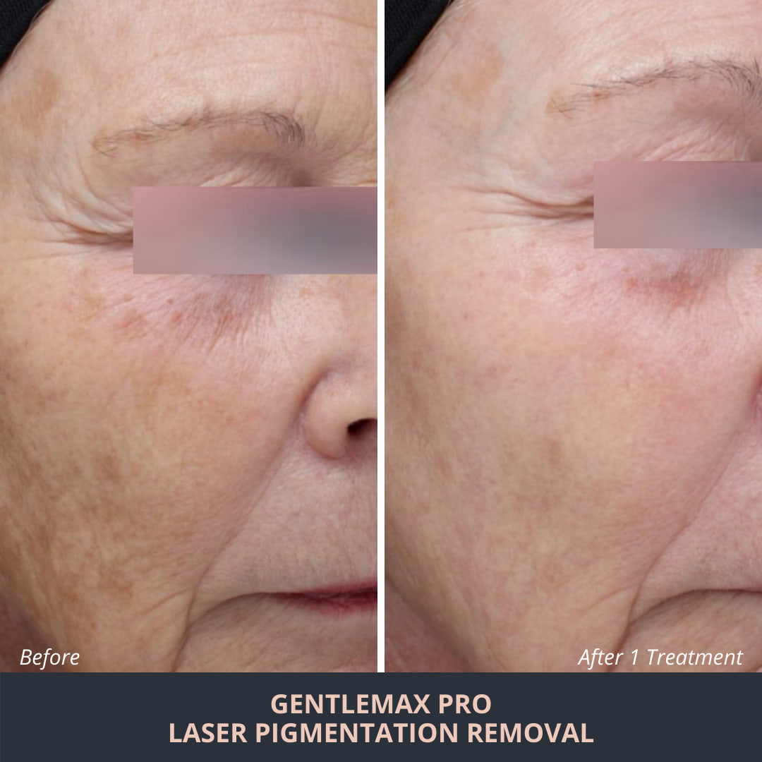 laser-pigmentation-removal-results