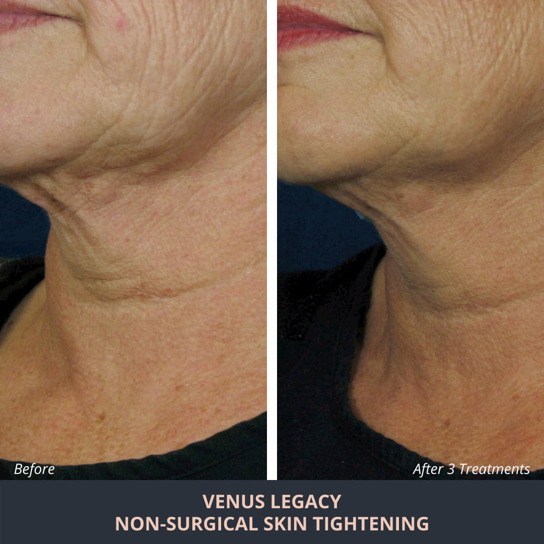 Radio Frequency Skin Tightening Novuskin