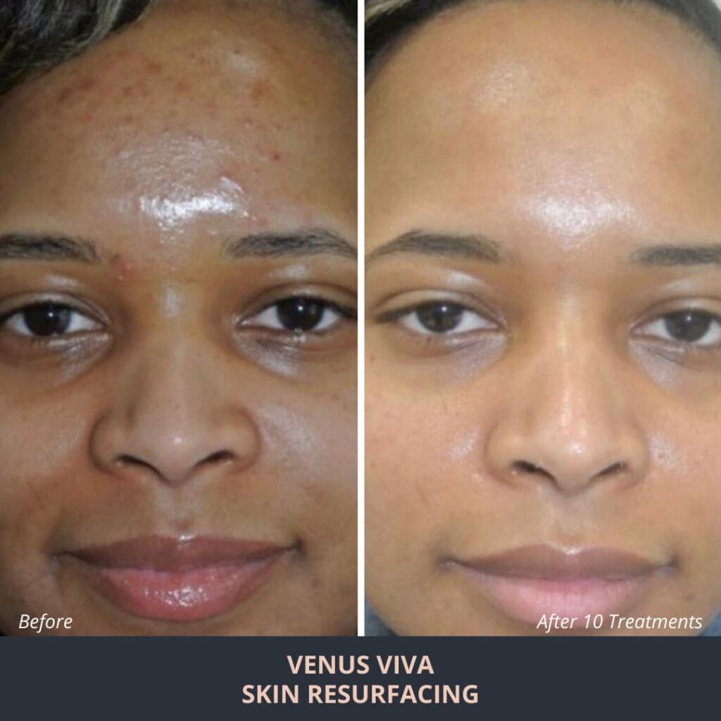Skin Resurfacing Novuskin