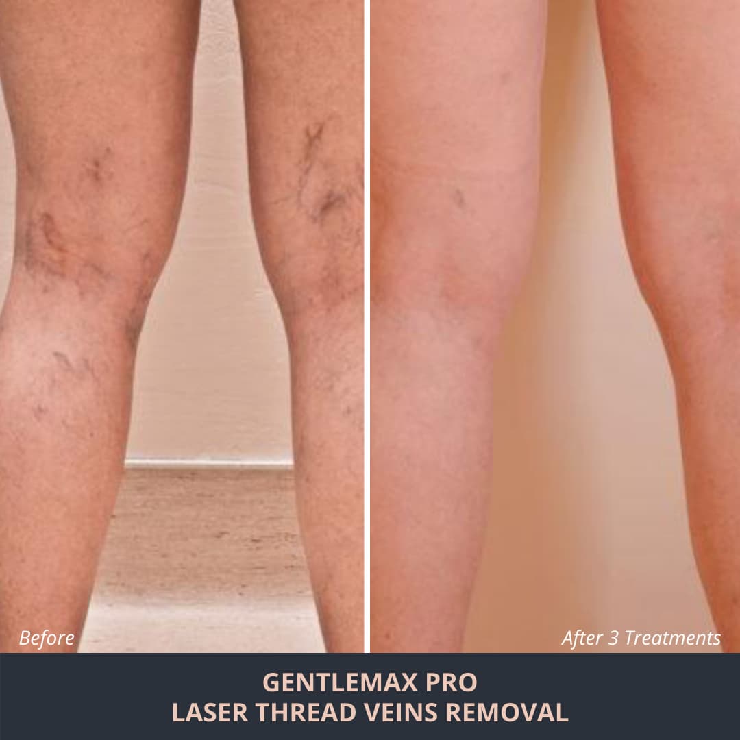 No.1 Best Spider Vein Treatment Adelaide - Laser for Spider Veins