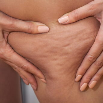 symptoms-of-cellulite