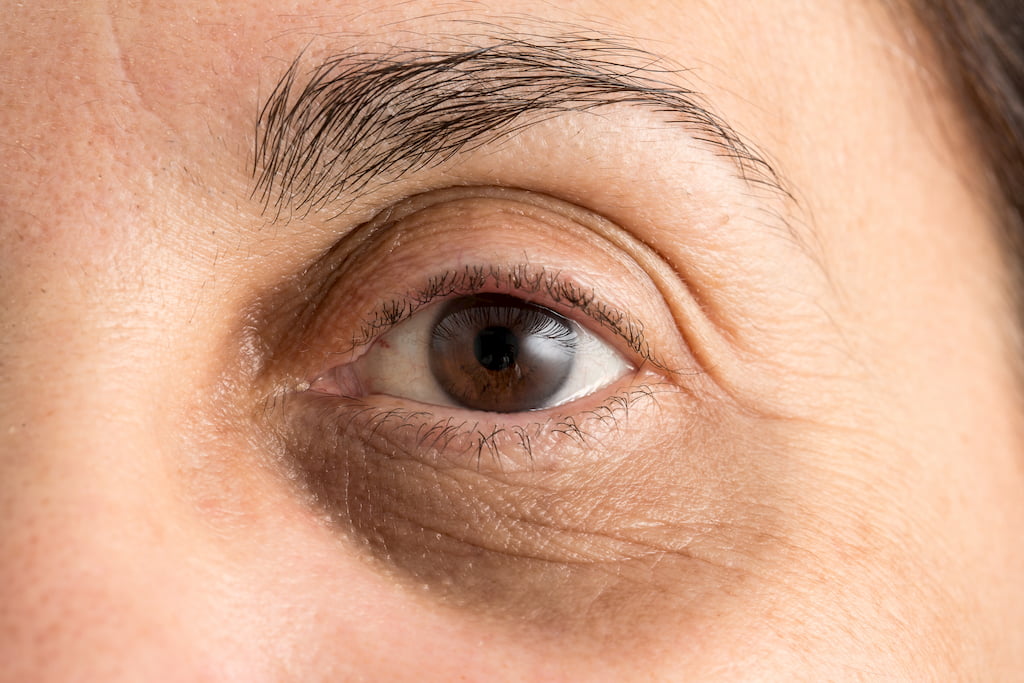 Difference between Eye Bags and Puffy Eyes, Treatments