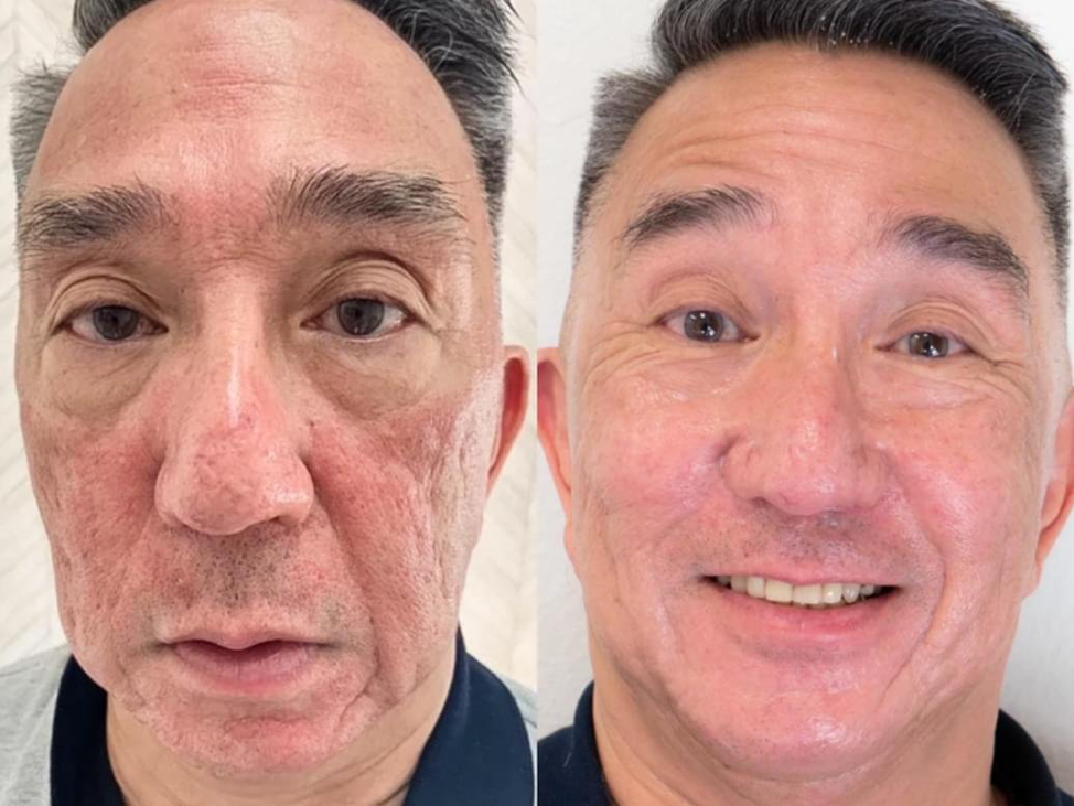 Skin looks younger and clearer after treatment