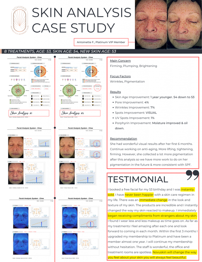 Skin Analysis case study show skin improvement after 8 treatments