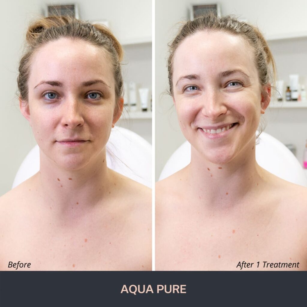 AquaPure - Novuskin