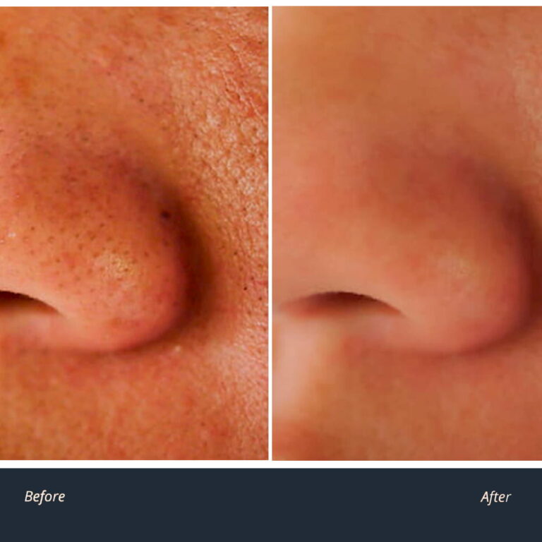 Blackheads and clogged pores treatment help removal sebum plugs and