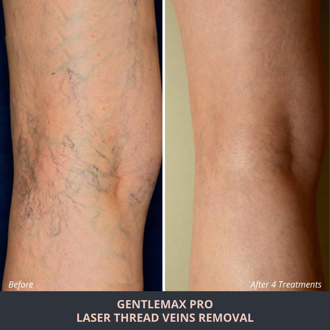 No.1 Best Spider Vein Treatment Adelaide - Laser for Spider Veins