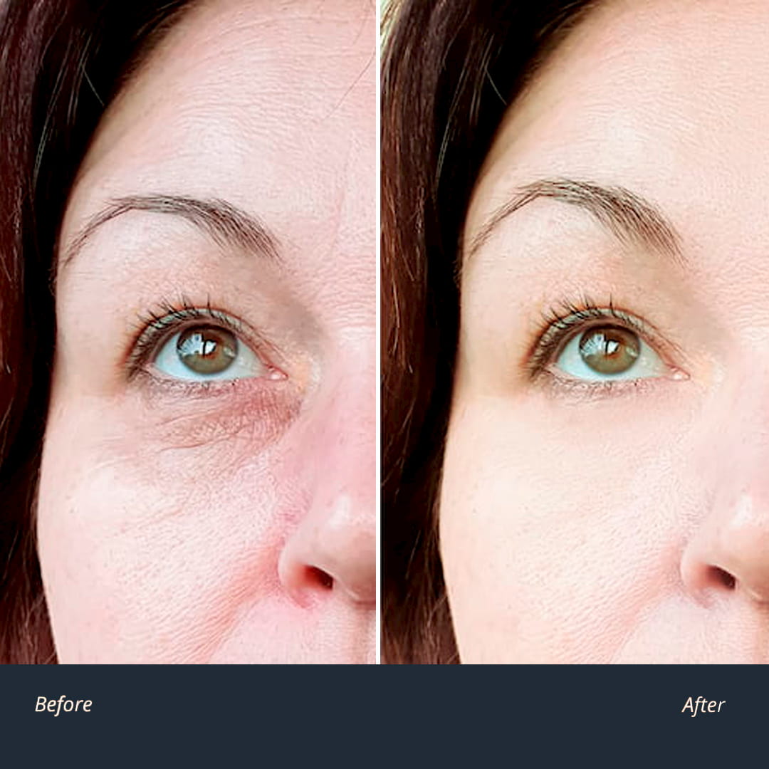 Eye bags and dark circles under eyes treatment: help reduce puffy eyes and  dark eyelids