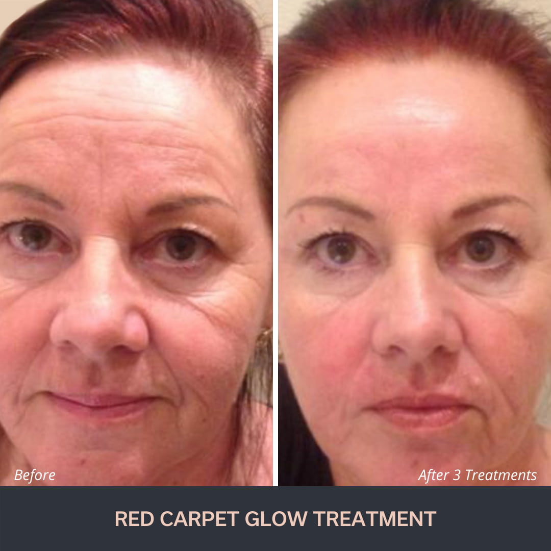 What is a Red Carpet Facial? 