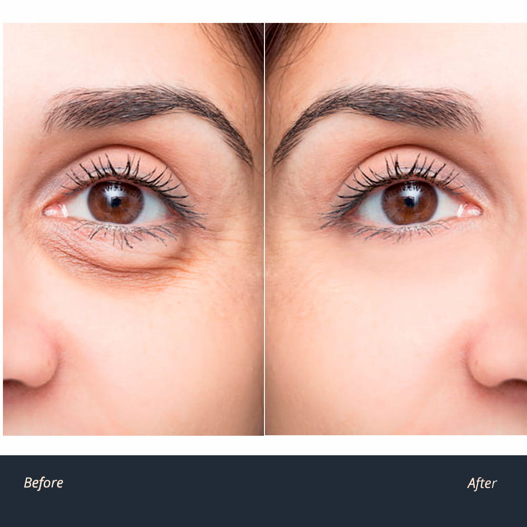 eyes dark circles before after