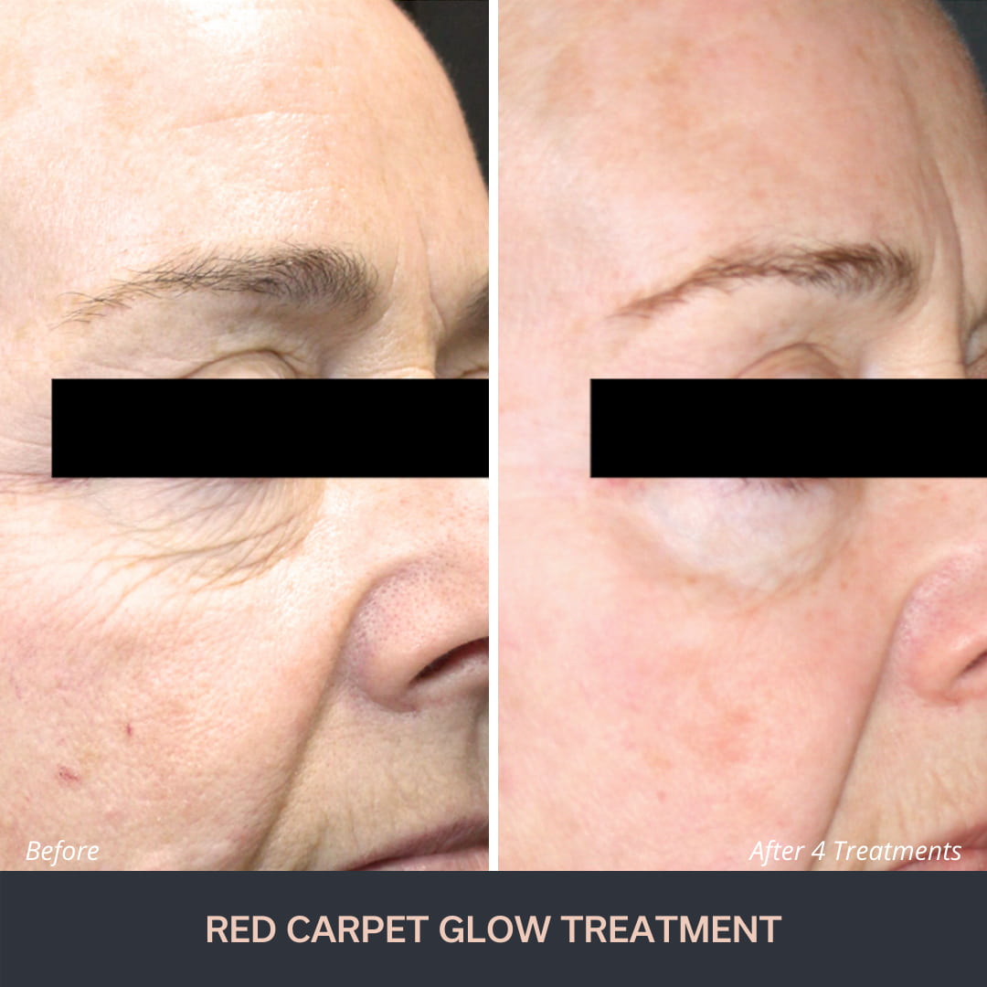 Red Carpet Facial -