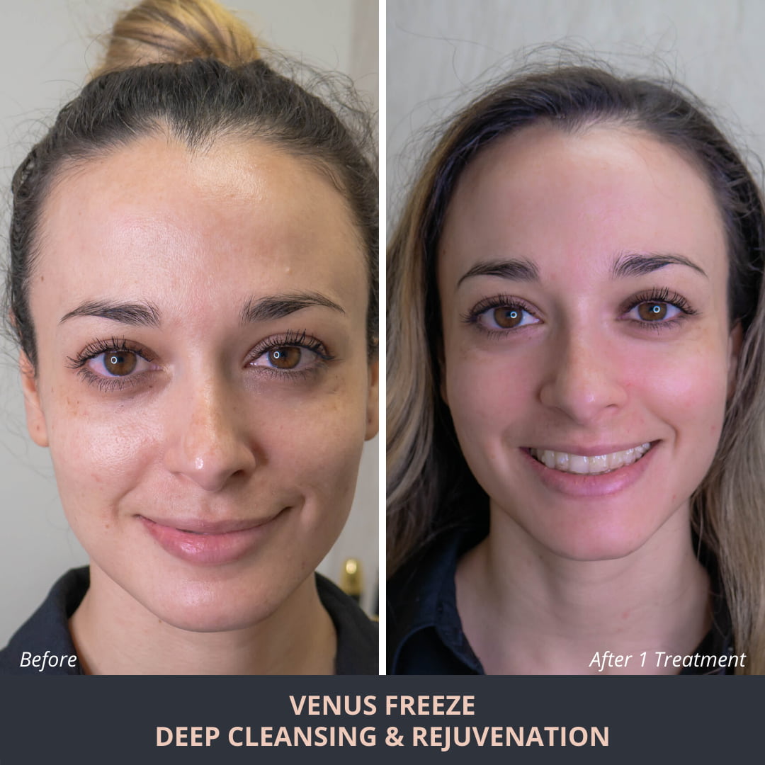 venus legacy machine before and after