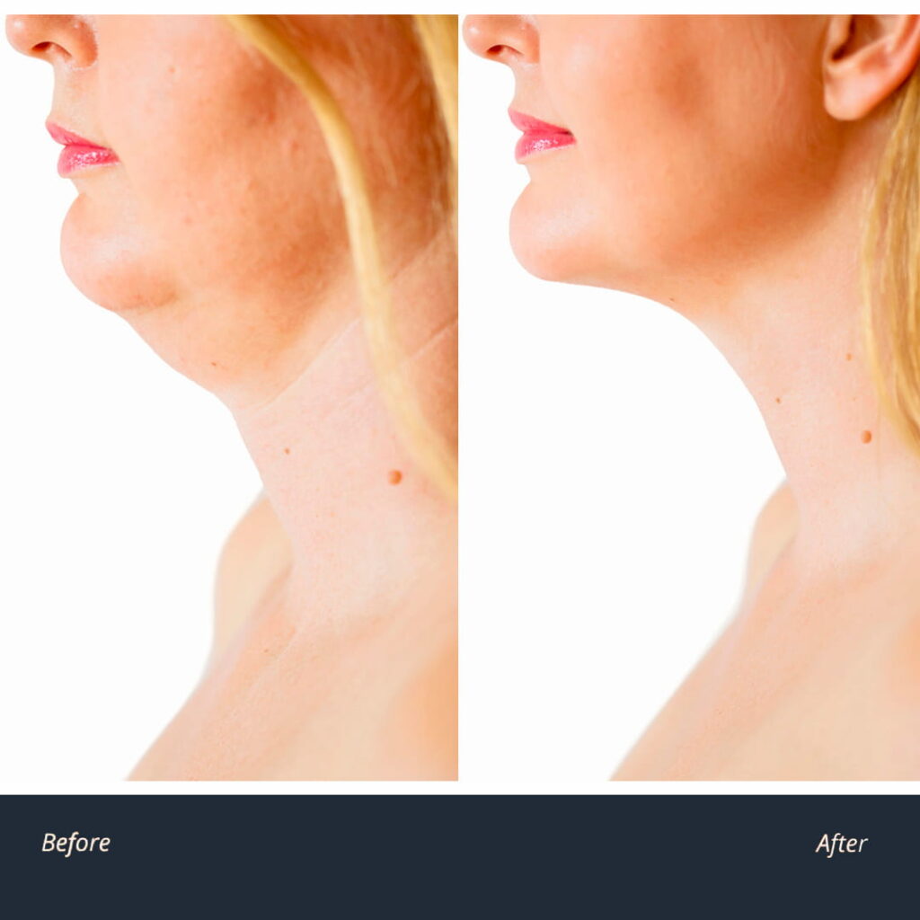 Turkey neck treatment help removal sagging neck skin Novuskin