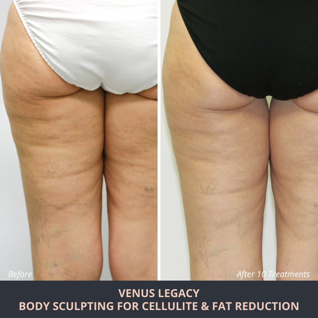 Cellulite - Novuskin