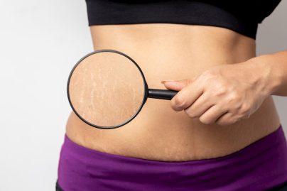 Stretch Marks Removal