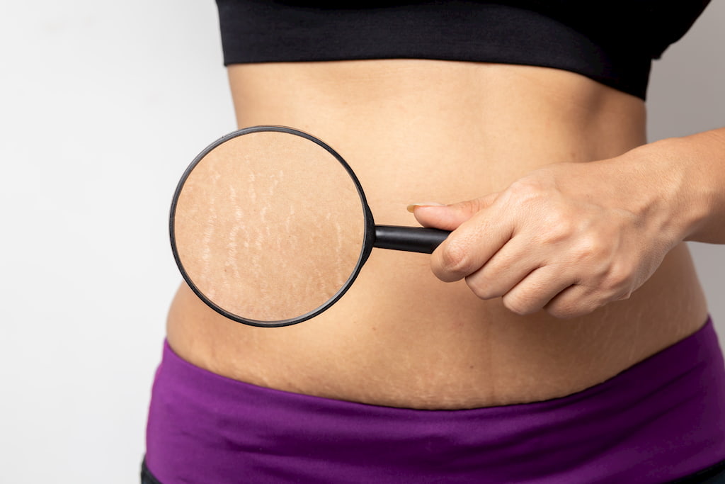 Stretch Marks Removal