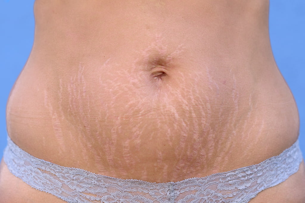 Understanding the Science Behind Stretch Marks & How to Treat Them