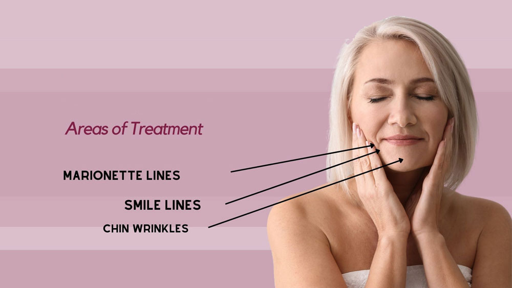 Sculptra-for-Wrinkle-Reduction
