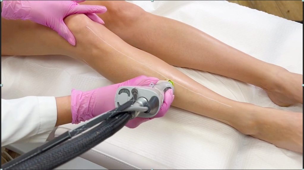 legs Laser Hair Removal