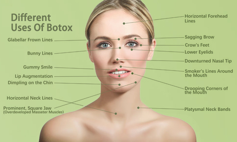 botox uses